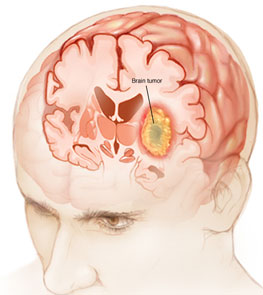 Brain Tumor