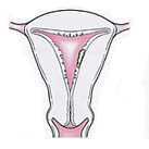 Endometrial Cancer Treatment