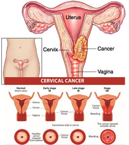 Cervix Cancer