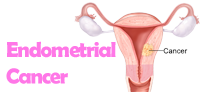 Endometrial Cancer