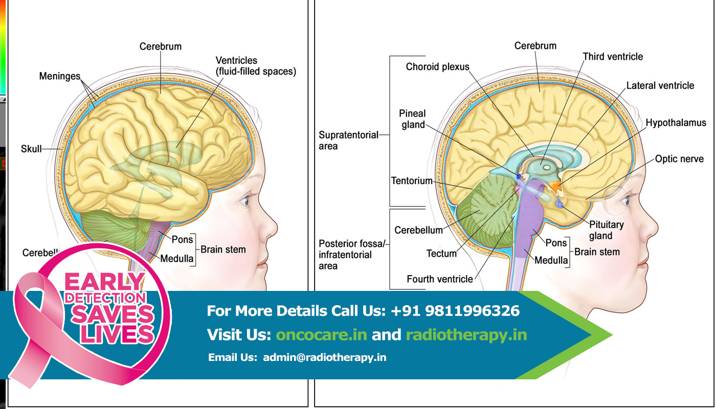 Glioma Treatment in India
