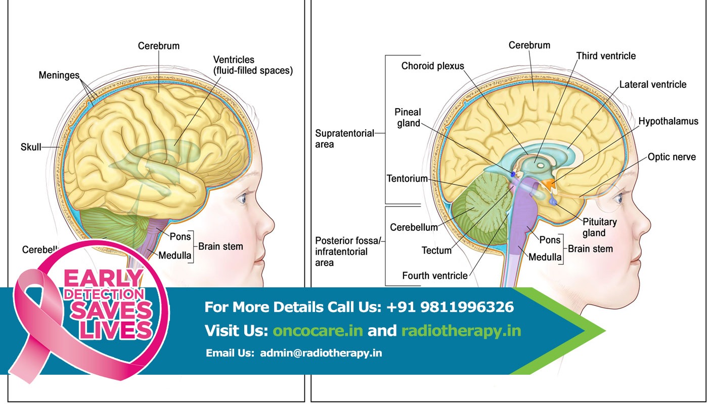 glioma