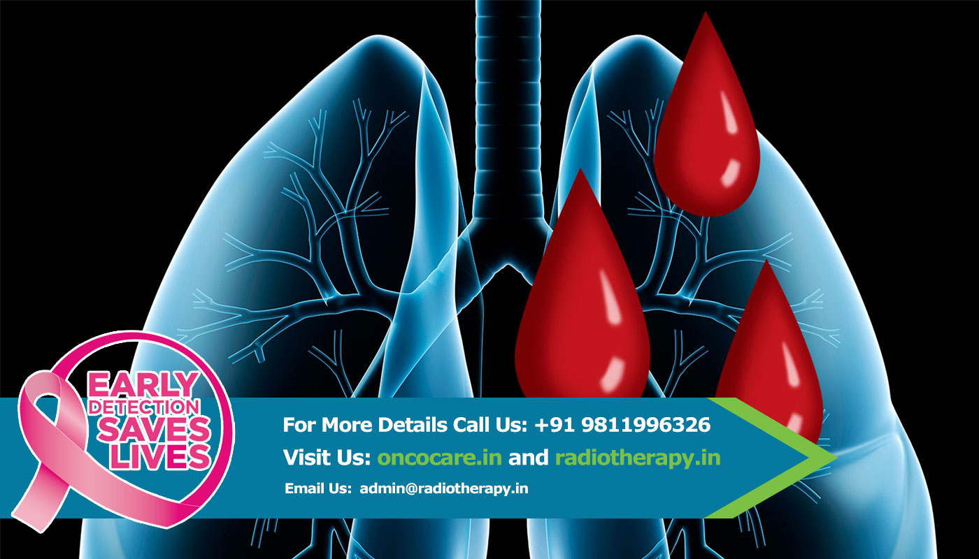 Lung Cancer Treatment in Delhi