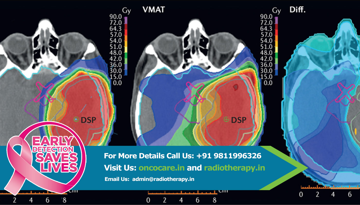 sbrt treatment in delhi